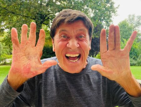 Gianni Morandi mostra le mani senza bende: “Voglia di urlare” (FOTO) Gianni Morandi mostra le mani ustionate senza bende