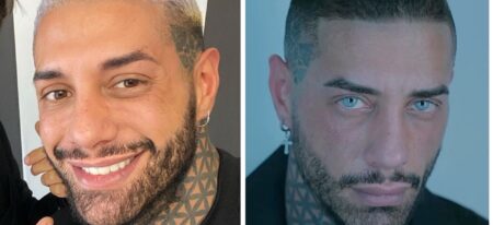 Francesco Chiofalo prima e dopo, che interventi ha fatto oltre quello agli occhi Francesco Chiofalo prima e dopo gli interventi agli occhi