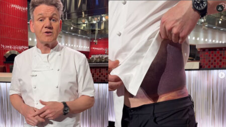 Il livido di Gordon Ramsay dopo l'incidente