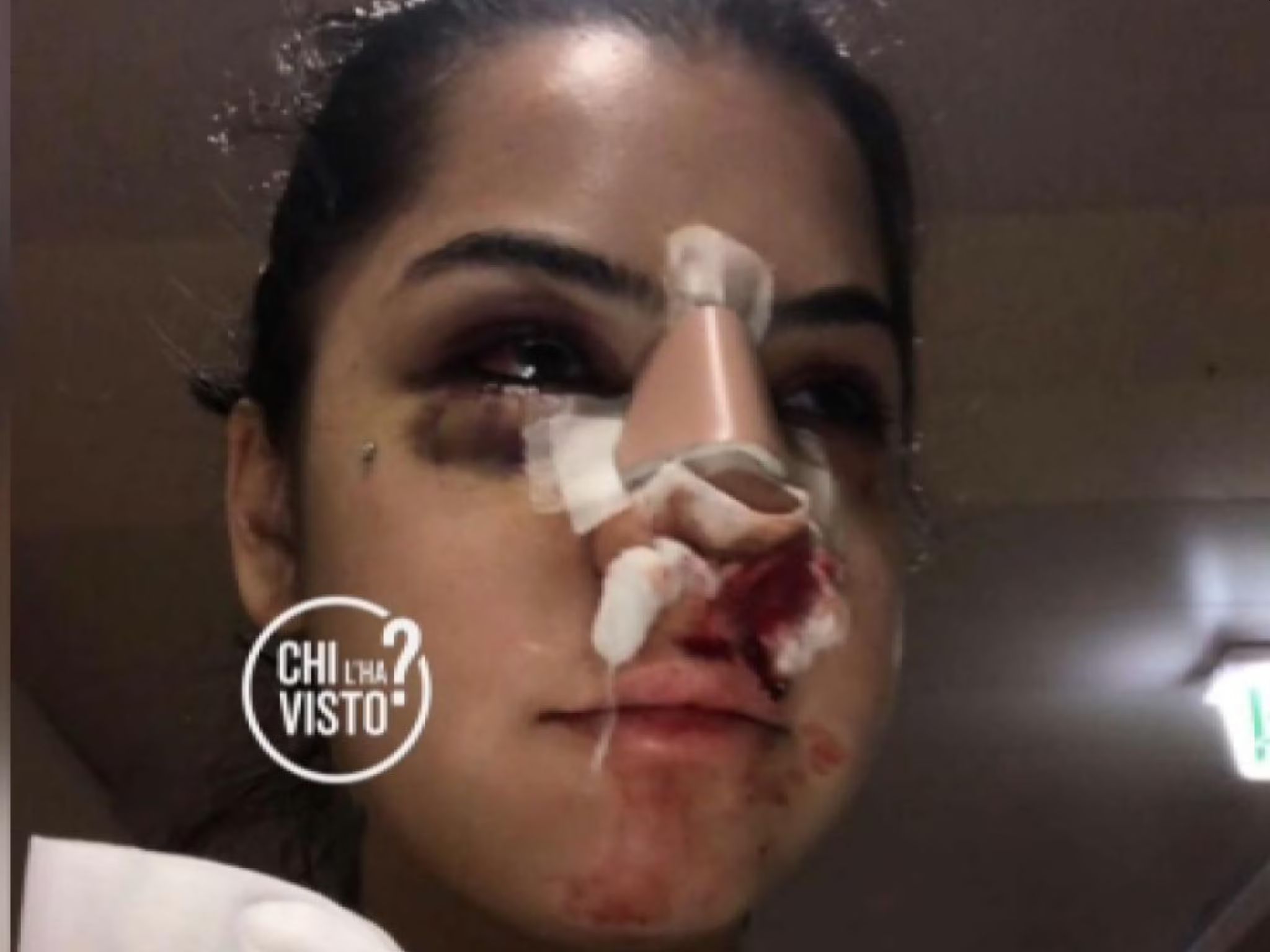 Chiara Balistreri in ospedale col naso rotto