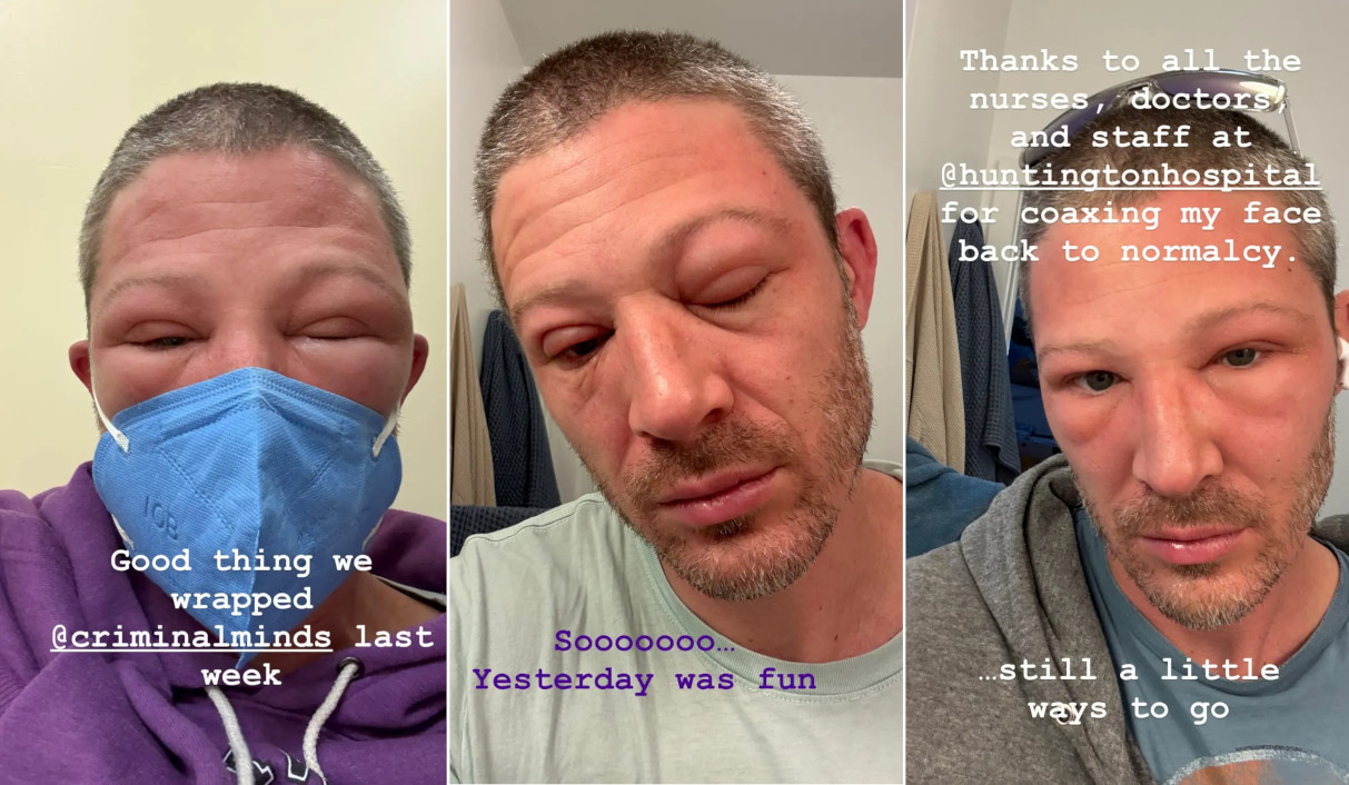 Zach Gilford col viso gonfio