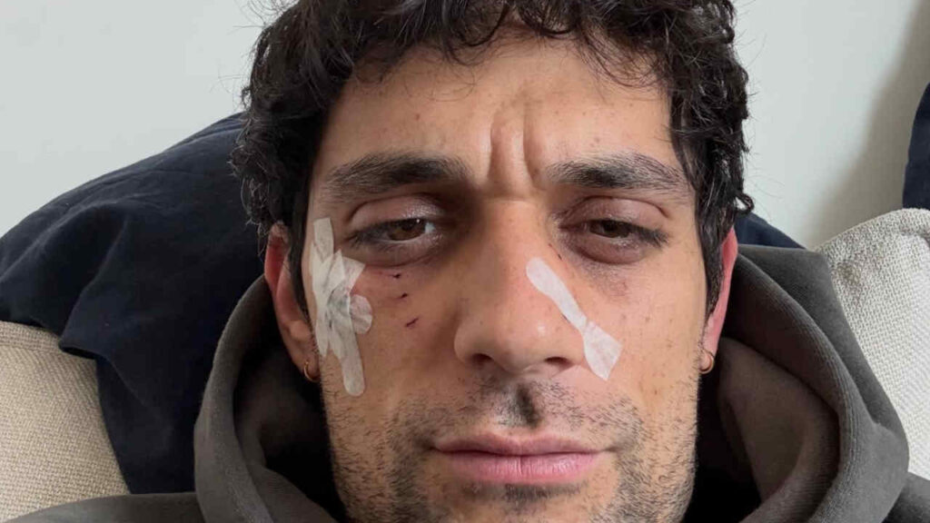 Bresh aggredito da un dobermann: “L’abbiamo chiusa in maniera diplomatica, mi ha chiesto scusa” Bresh ferito da un dobermann