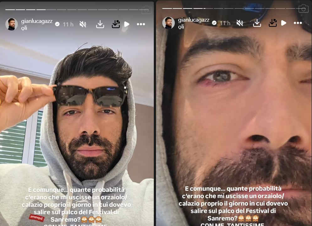 Gianluca Gazzoli mostra l'occhio con l'orzaiolo