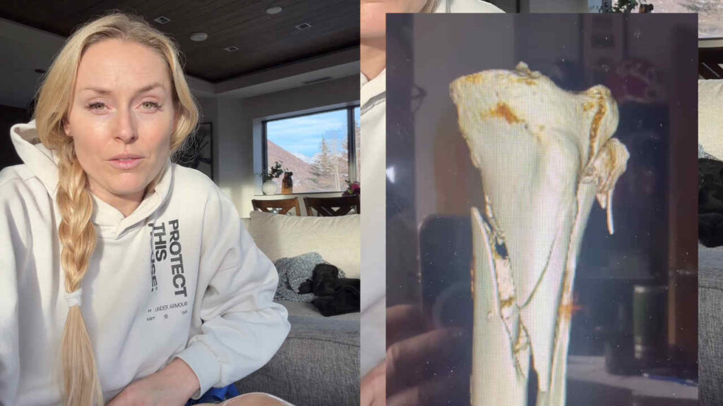 Lindsey Vonn: “Il chirurgo mi ha salvato la gamba dall’amputazione dopo il crash olimpico” Lindsey Vonn con la gamba fratturata