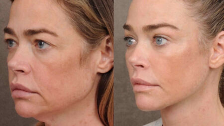 Il lifting di Denise Richards prima e dopo