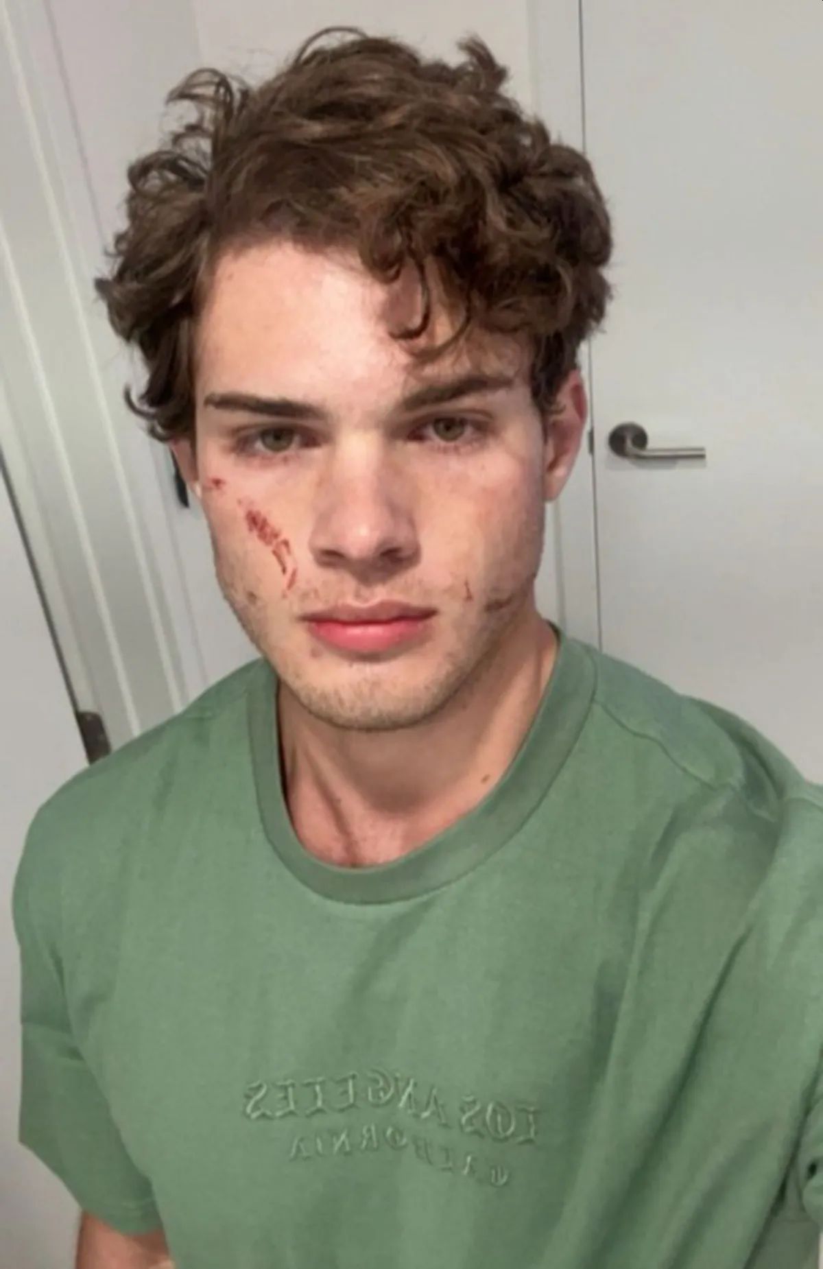 Clavicular col volto graffiato