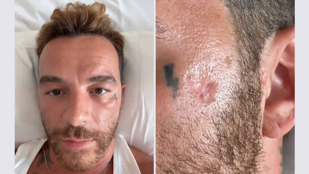 Salmo rivela: “Ho un cancro alla pelle”. Il video su TikTok e le accuse alle creme solari fanno discutere Salmo mostra il tumore della pelle