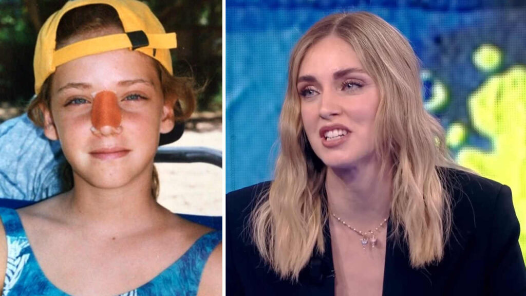 Chiara Ferragni da piccola col naso rotto